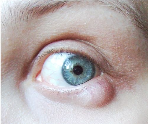 What are the symptoms of eyelid cysts?