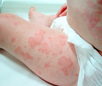 Hives in Children causes
