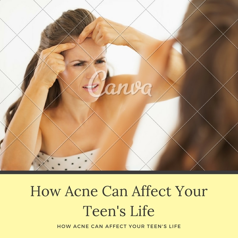How Acne Can Affect Your Teens Life