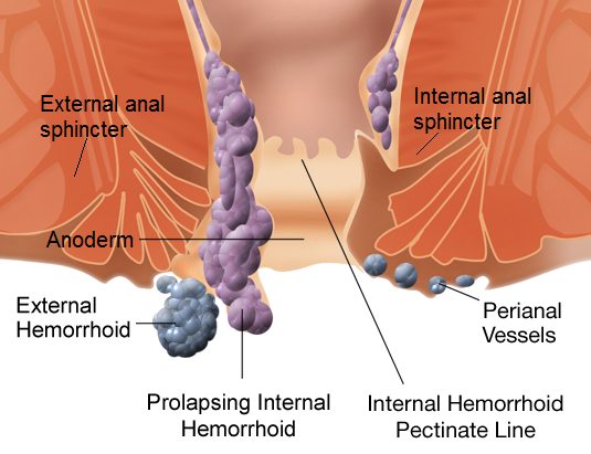 Internal and external hemorrhoids