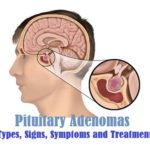 Pituitary Adenomas : Types, Signs, Symptoms and Treatment