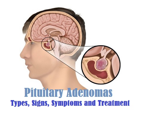 Pituitary Adenomas : Types, Signs, Symptoms and Treatment
