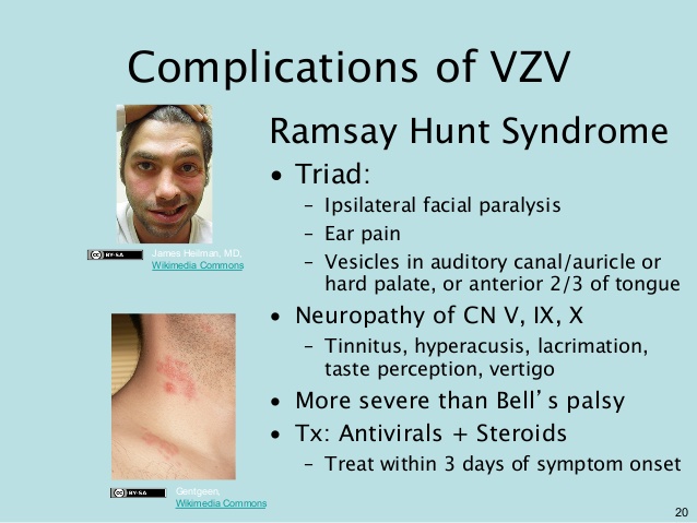 Ramsay Hunt Syndrome complications