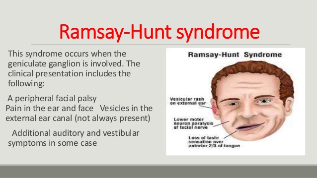 Ramsay Hunt Syndrome