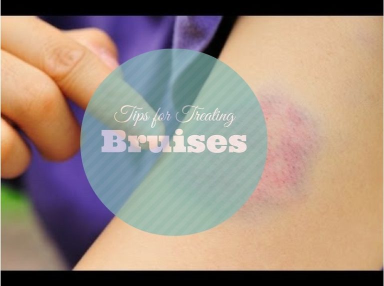 Top Tips For Treating Bruises Causes Of Bruises