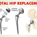 total-hip-replacement