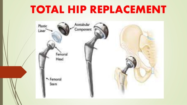 total-hip-replacement