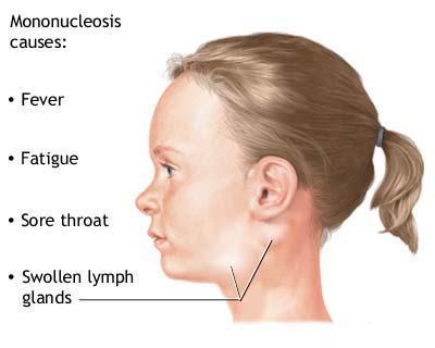 causes-of-Glandular-fever