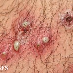 Infected Hair Follicle