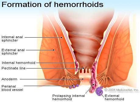 hemorrhoid