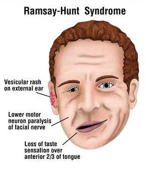 ramsay hunt syndrome pictures