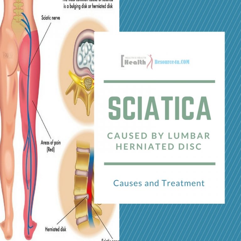 Sciatica from Lumbar Herniated Disc