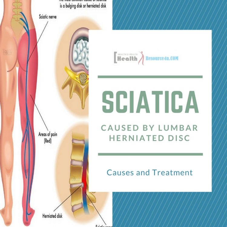 Sciatica from Lumbar Herniated Disc e1521332846195