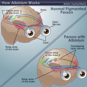 how albinism works