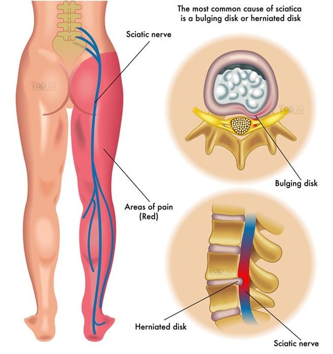 Prevention of Sciatica Caused by Herniated Disc: