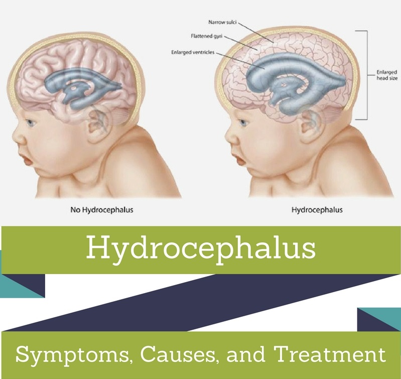 hydrocephalus Symptoms, Picture, Causes, and Treatment