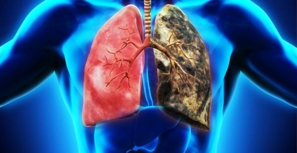 Lung Cancer