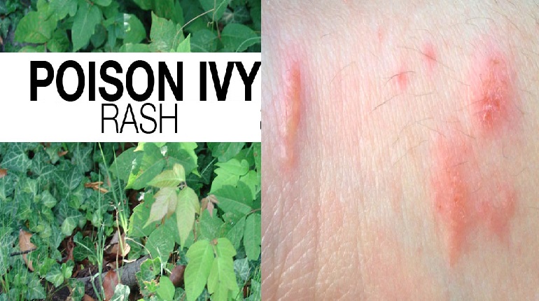 Poison Oak Rash causes and treatment