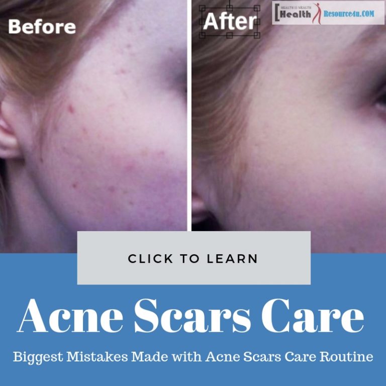 Acne Scars Care Routine