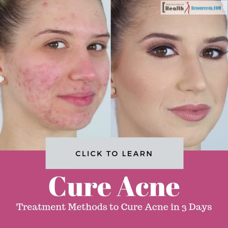 Cure Acne in 3 Days