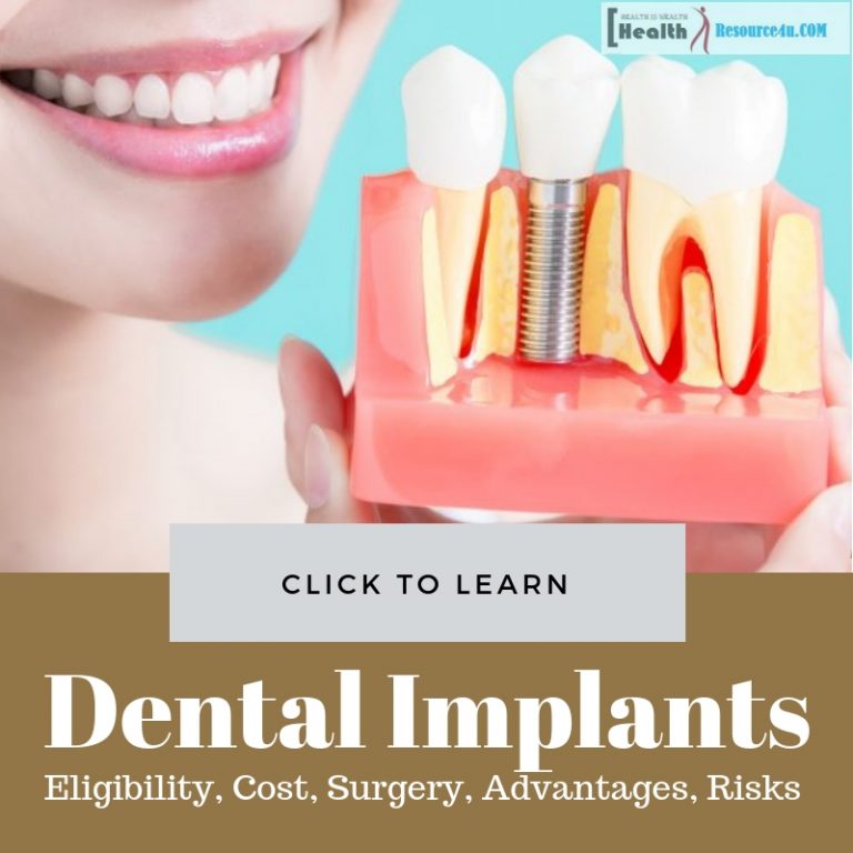 Dental Implants