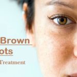 Facial Brown Spots