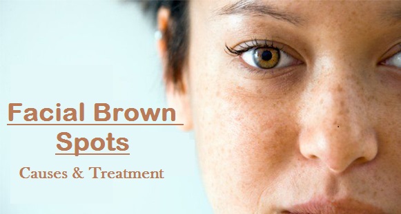 Facial Brown Spots Causes Picture Symptoms And Treatment