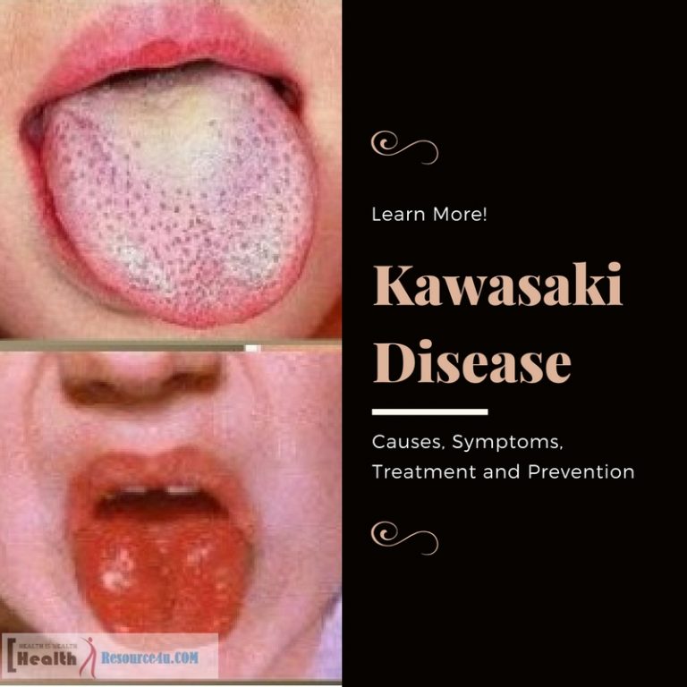 Kawasaki Disease Causes Treatment