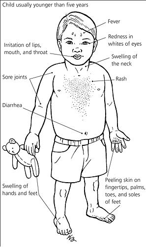 Kawasaki disease causes