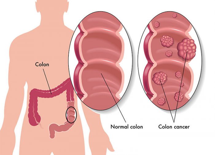 Symptoms of Colon Cancer