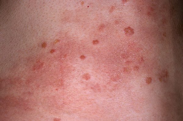 hiv rash