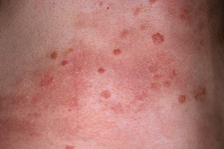 Rashes After Sex 113