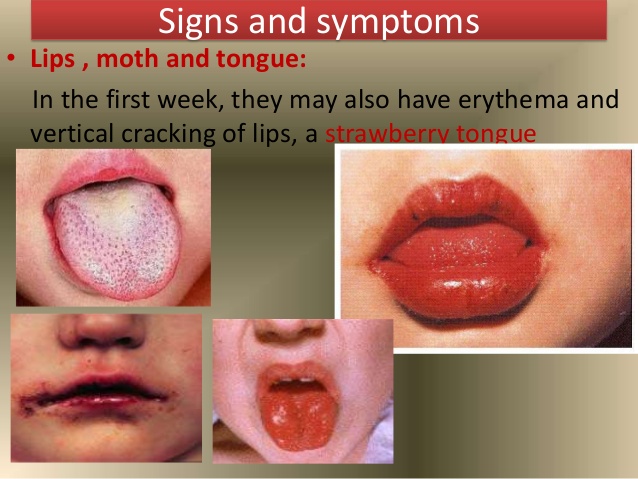 Symptoms of Kawasaki Disease 