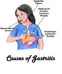 Causes-of-Gastritis