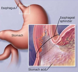 Gastritis symptoms and treatment