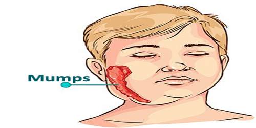 Mumps