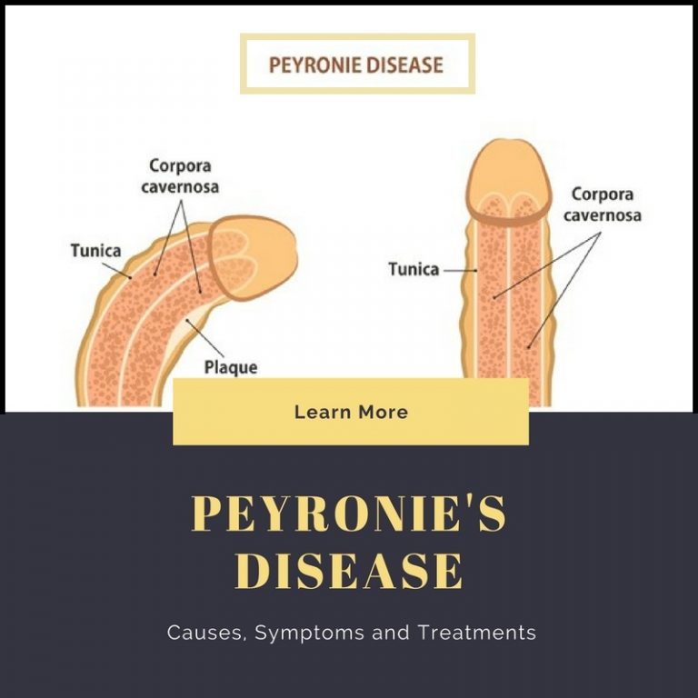 Peyronies Disease Causes