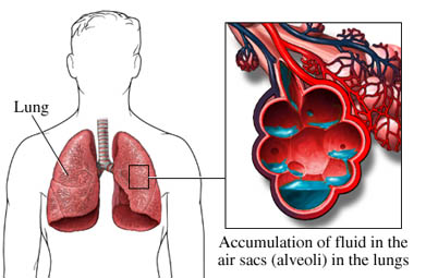 Pulmonary Edema treatment