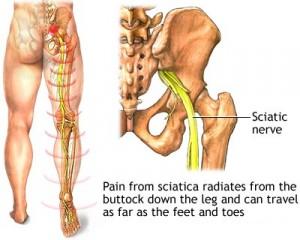 Sciatica