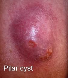 What are some causes of cysts?