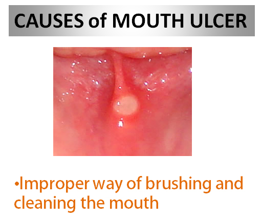 Causes of Mouth Ulcer small