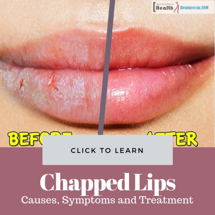 Chapped Lips Causes Treatment