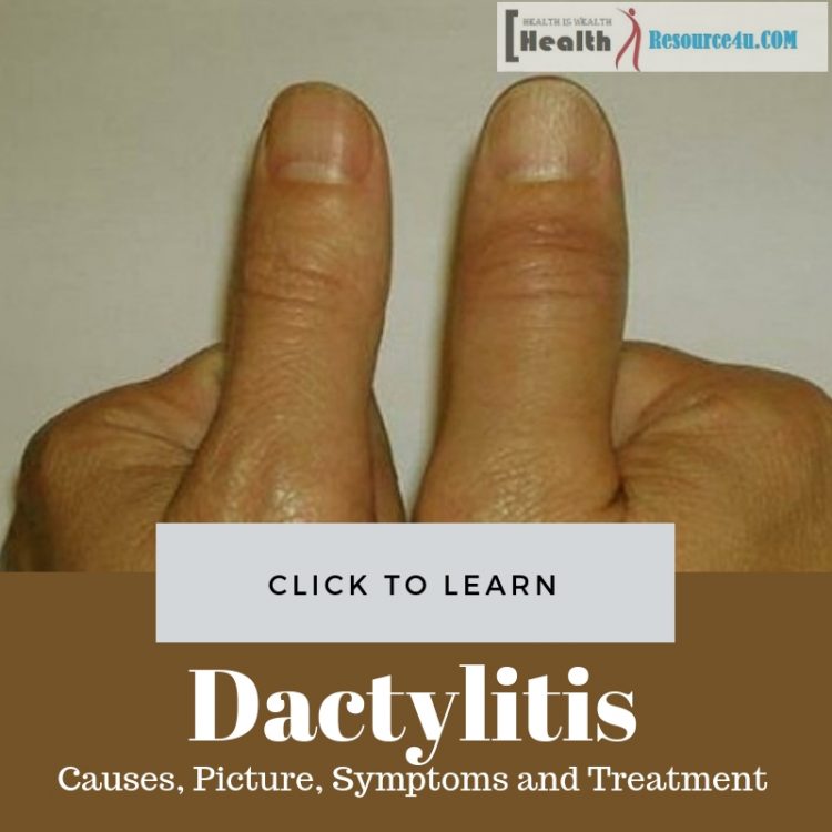 Dactylitis Picture
