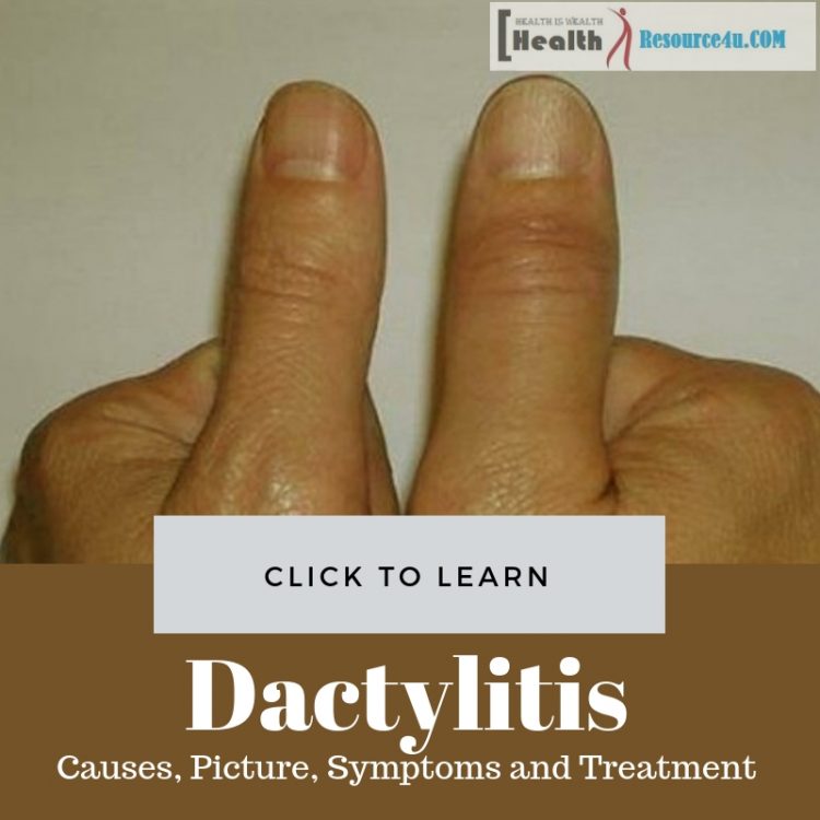 dactylitis