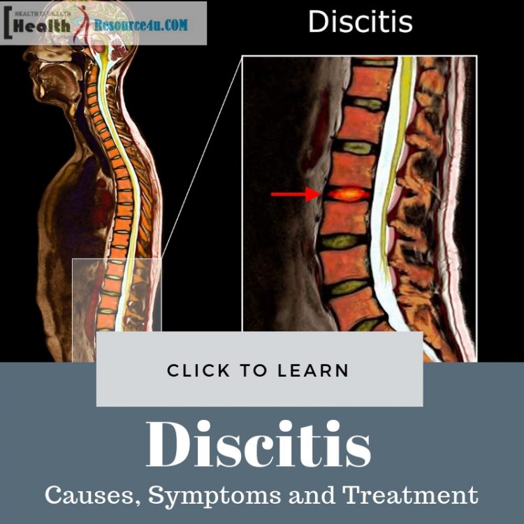 Discitis Causes and Treatment