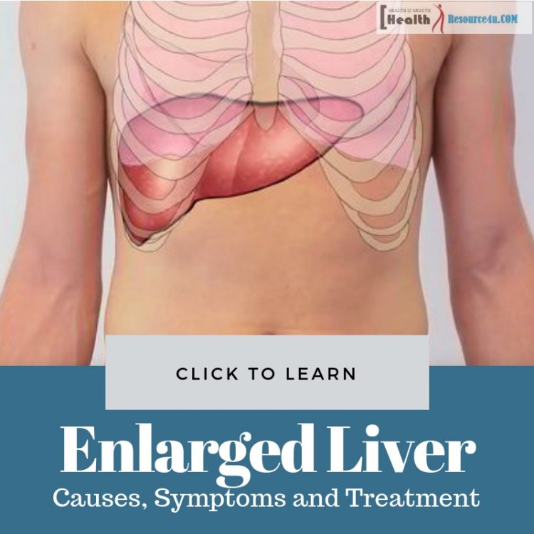Enlarged Liver Hepatomegaly