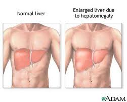 Enlarged Liver or hepatomegaly Picture