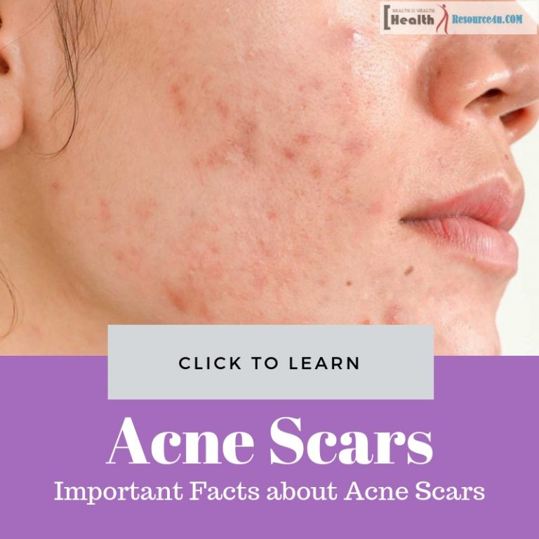 Important Facts about Acne Scars