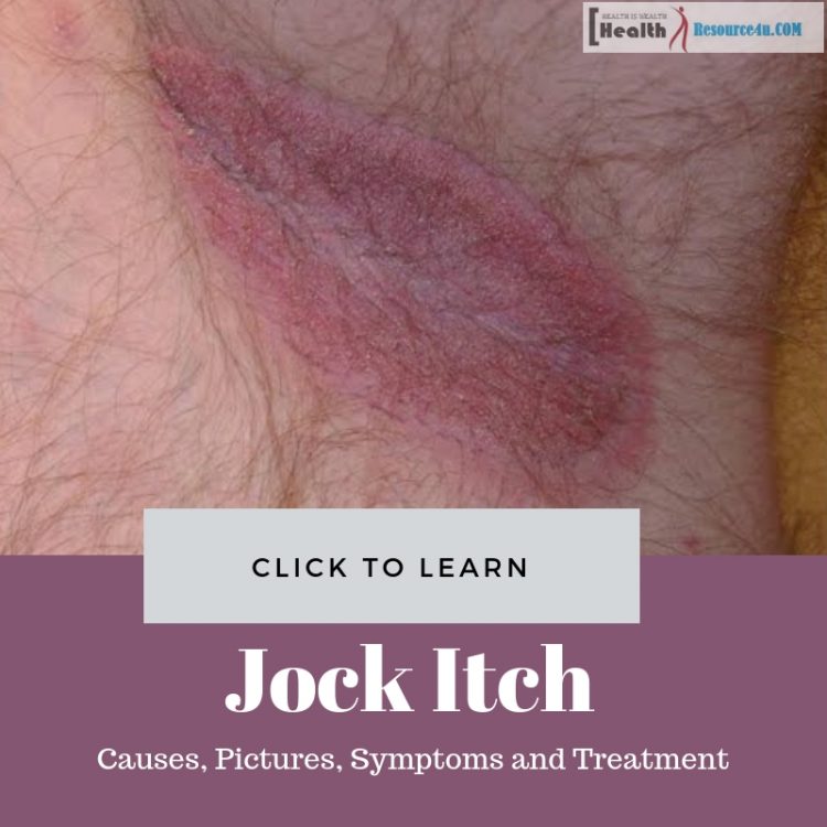 Jock Itch Picture