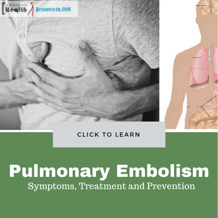 Pulmonary Embolism